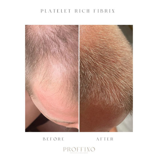 Platelet Rich Plasma