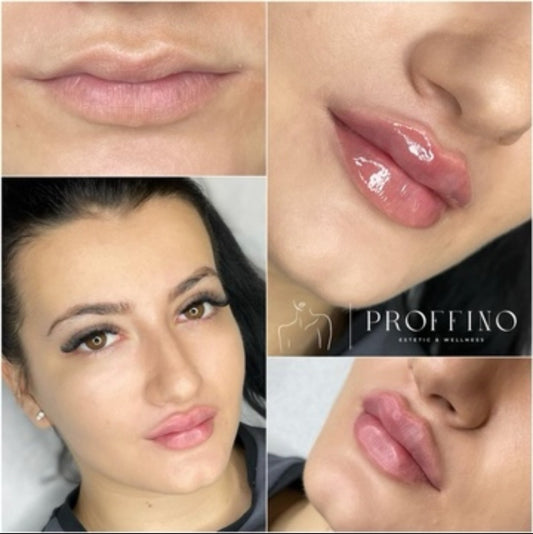 Lip Filler Russian Lips